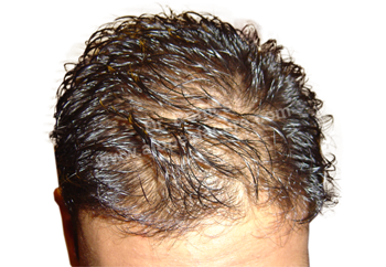 Diffuse Patterned Alopecia